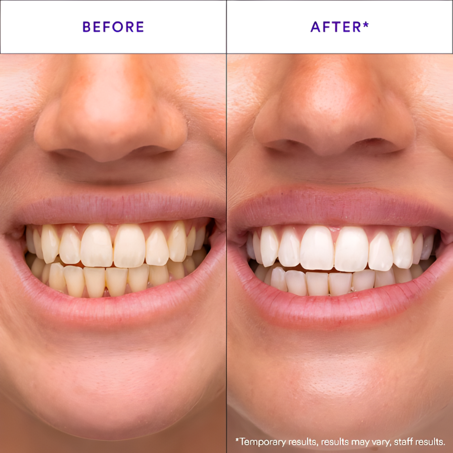 V34 Whitening Strips